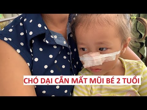 Đau đớn bé gái 2 tuổi xinh xắn bị chó dại cắn nát mũi